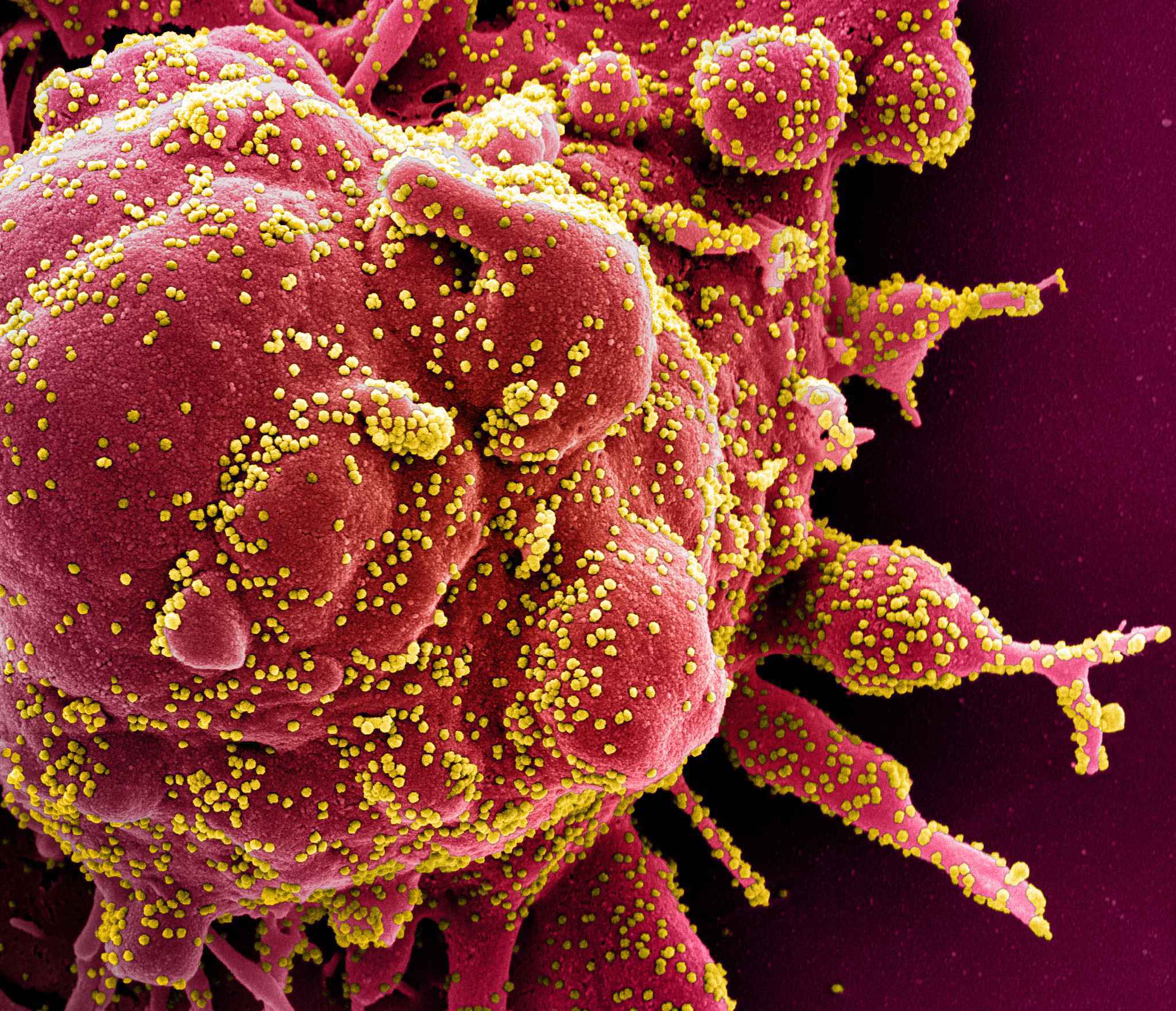 Micrografia eletrônica de varredura colorida de uma célula apoptótica (vermelha) fortemente infectada com partículas do vírus SARS-COV-2 (amarela), isoladas de uma amostra de paciente