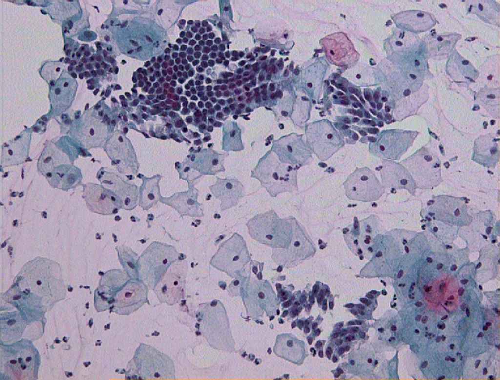 Imagem microscópica do exame de papanicolau