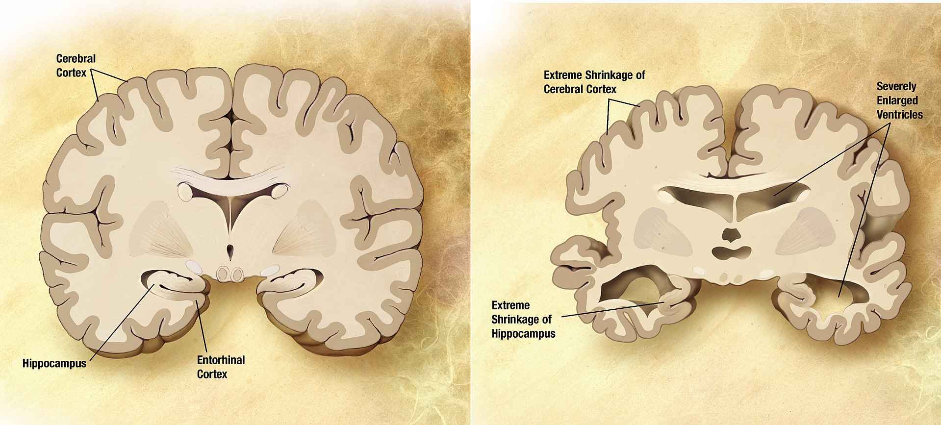 Comparação entre um cérebro idoso normal (esquerda) e o cérebro de uma pessoa com Alzheimer (direita)