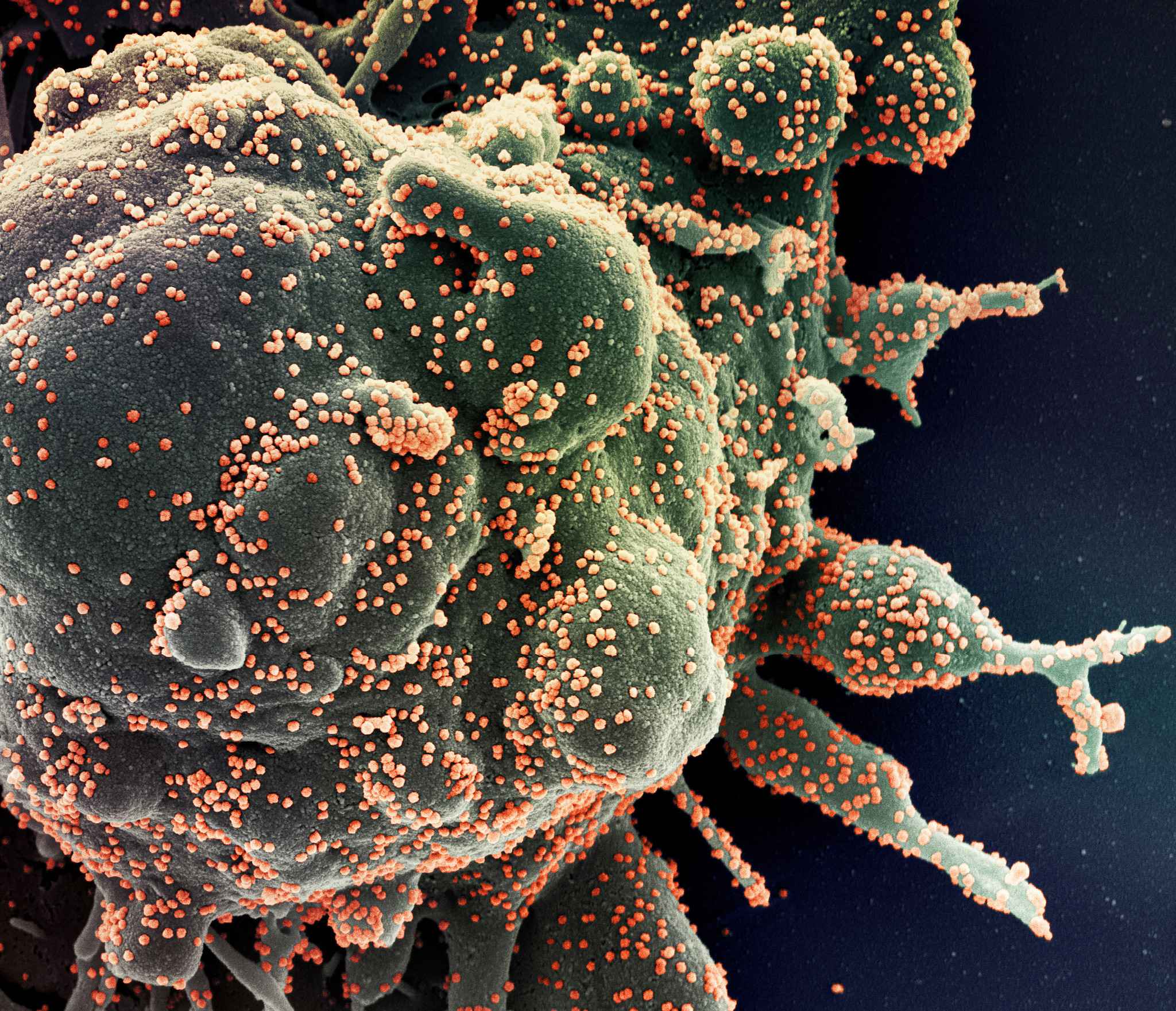 Micrografia eletrônica de varredura colorida de uma célula apoptótica (verde) fortemente infectada com partículas do novo coronavírus (laranja), isoladas de uma amostra de paciente