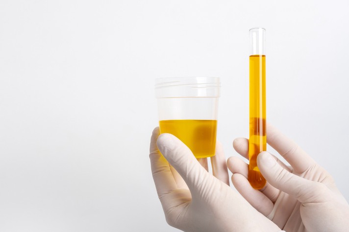 Teste com o uso da urina é menos invasivo e propicia maior praticidade no armazenamento e na coleta