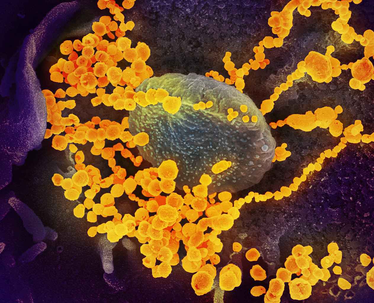 Partículas de coronavírus (amarelo) em torno de uma célula humana. Imagem foi obtida por microscópio eletrônico de varrimento com coloração digital