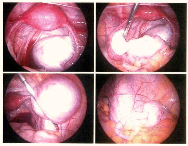Endometriose observada durante uma laparoscopia