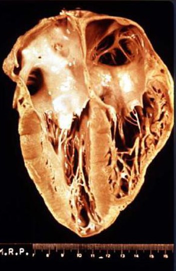 Peça anatômica de um coração acometido pela doença de Chagas crônica