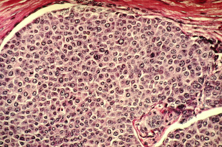 Representação de células do câncer de mama: