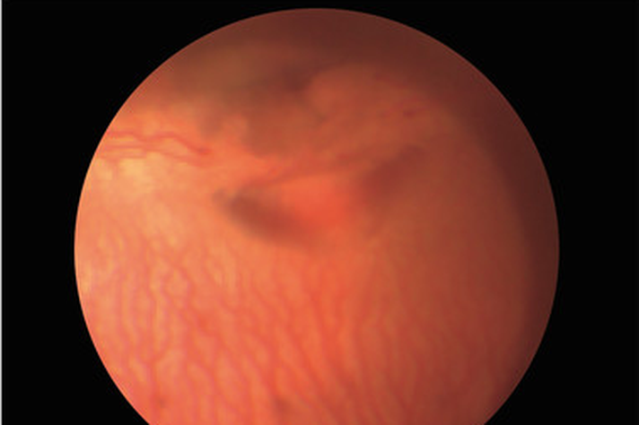 Oftalmoscopia com os vasos normais da retina e o disco óptico