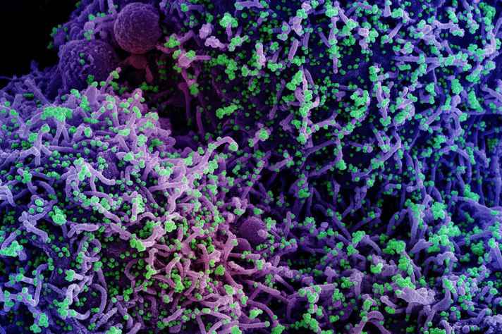 Micrografia eletrônica de varredura de uma célula infectada com Sars-coV-2, isolada de uma amostra de paciente e colorida