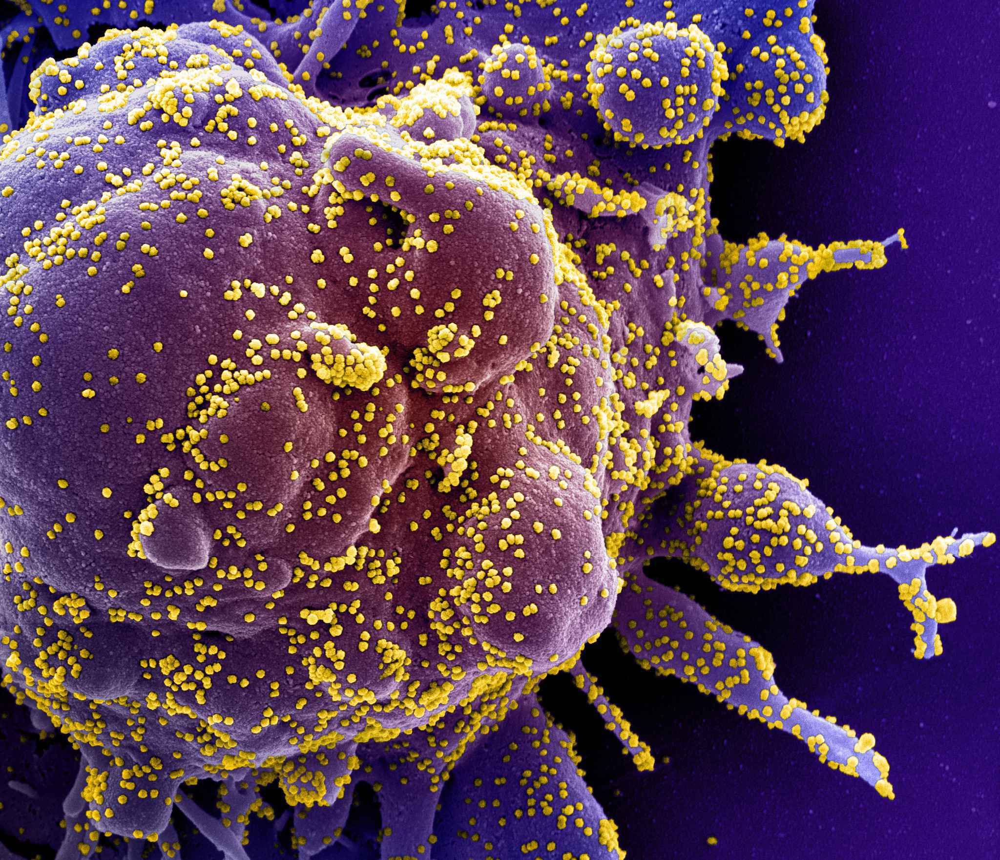 Imagem obtida por microscópio eletrônico de transmissão (MET) de partículas de Sars-CoV-2 (em amarelo) isoladas de um paciente